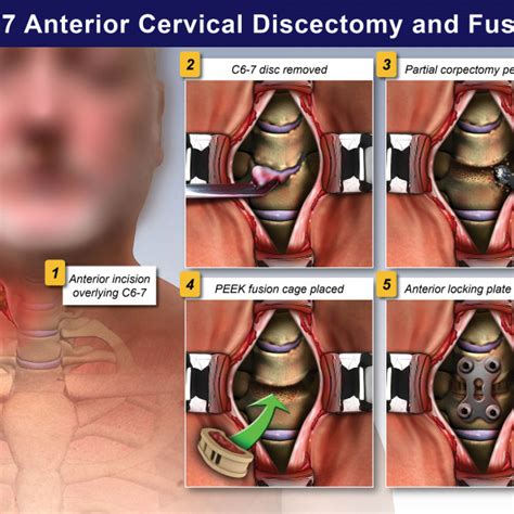 C6 7 Anterior Cervical Discectomy And Fusion