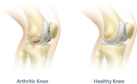 rosa knee system summit orthopaedics
