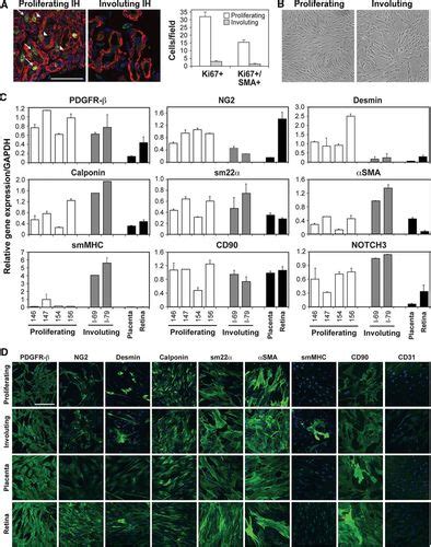 pericytes from infantile hemangioma display proangiogenic properties and dysregulated