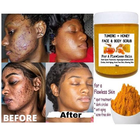 turmeric scrub acne dark spots eraser  skin tone etsy   acne dark spots  skin