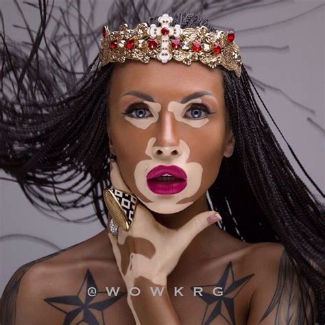 Winnie Harlow A Model That Was Born With Vitiligo A Condition That