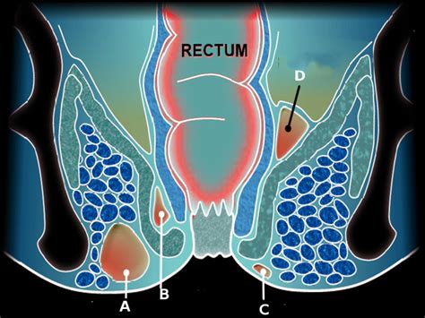 [figure perirectal abscess] statpearls ncbi bookshelf