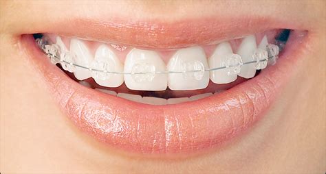 Fast Orthodontic Treatment – How It Differs From Standard Braces Blog