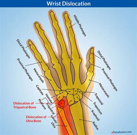 wrist dislocationtypescausessignssymptomstreatmentexercisesinvestigations