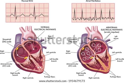 1 Medical Illustration Showing Symptoms Heart Atrial Fibrillation