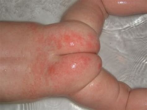 types  skin conditions  babies naturopathic health care centre