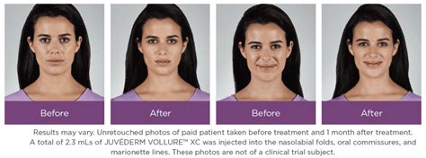 Juvederm Treatment Dermatology Care Of Charlotte