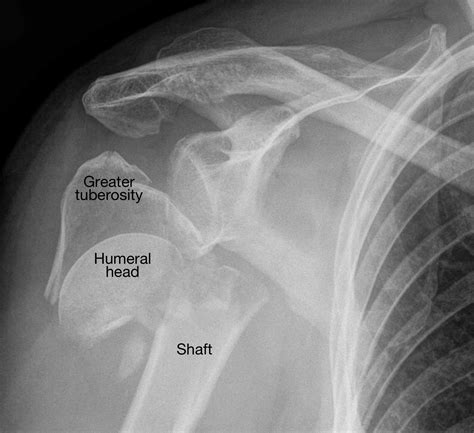 Rradiograph Shows A Proximal Humerus Fracture Shoulder