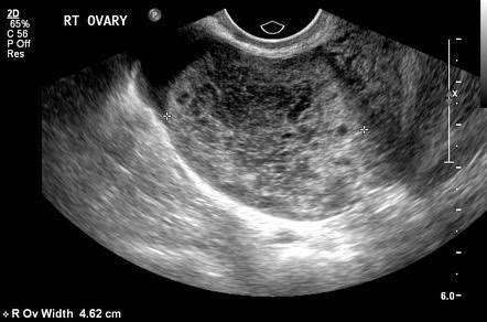 ovarian torsion detorsion radiology case radiopaediaorg