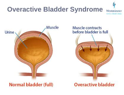 oab myths  misconceptions  overactive bladder whcr blog caio augusto fala das acoes da