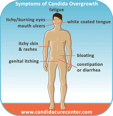 symptoms of candida albicans infection candida cure center