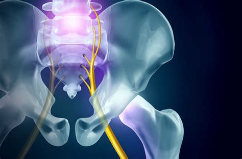 When To Suspect Your Lower Back Pain Is Actually Sciatica