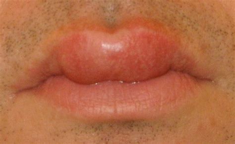 swollen lips  treatment pictures remedies