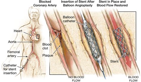 stents  treat coronary artery blockages cardiology jama jama