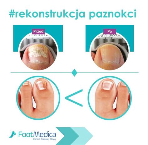 rekonstrukcja paznokcia kiedy paznokcie potrzebuja wsparcia podologa footmedica