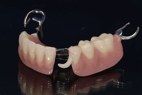 dental labs  dentures  arizona conventional full  partial dentures