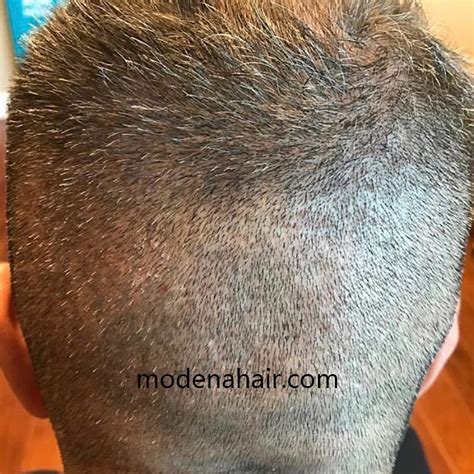 case study fue hair transplant donor area modena hair institute