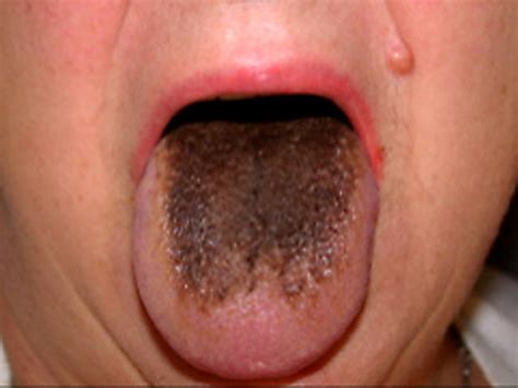 foul mouth what yucky signs say about your health photo 1 pictures cbs news