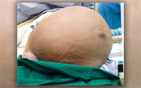 pumpkin size giant fibroid removed from woman s uterus live science