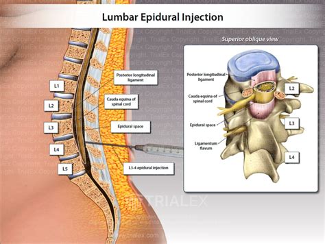 lumbar epidural spinal injection