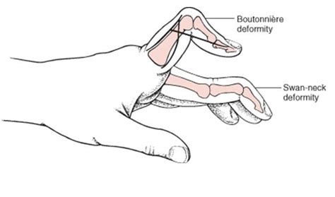 The Pulse Rheumatoid Arthritis Some Hand Findings