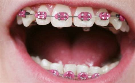 pink braces colors braces colors pink braces teeth braces