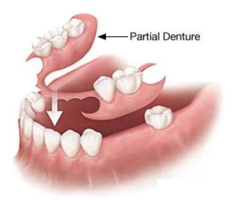 replacing missing teeth  options knoxville family dentistry