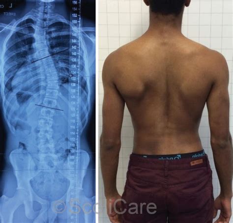 reduction  severe scoliosis    year  male patient