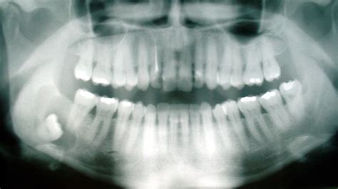 impacted wisdom teeth what you need to know westermeier martin