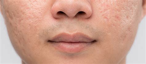 Types Of Acne Scars Re Equil