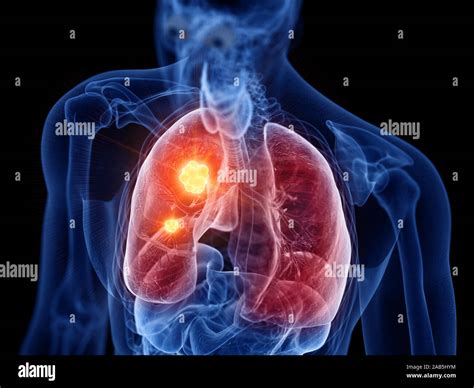Cancer Du Poumon Organes Pulmonaires Banque De Photographies Et D