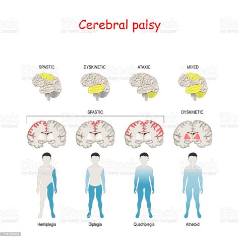 vetores de paralisia cerebral cerebro humano   area misturada