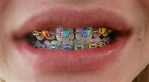 Bⓡⓐⓒⓔⓢ ⓒⓞⓛⓞⓡⓢ Braces Teeth Braces Cute Braces Colors Fake Braces