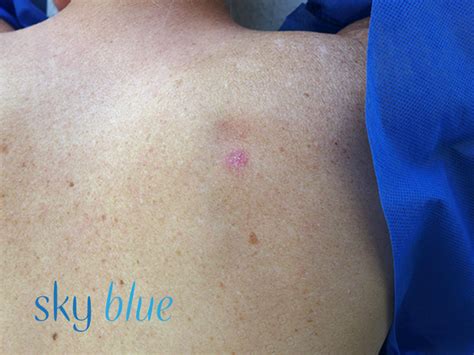 skin cancer        bit  sky blue dermatology