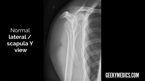 shoulder  ray interpretation radiology geeky medics