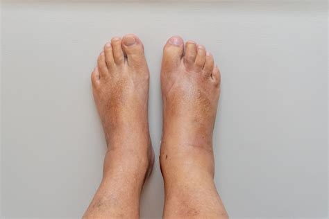 ms  swollen feet  symptoms  treatment