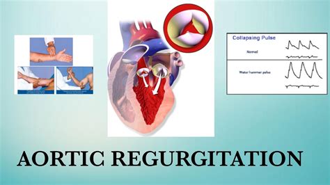 aortic regurgitation water hammer pulse rhd youtube