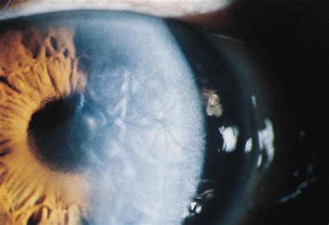 Bilateral Descemet Membrane Detachments Cataract And