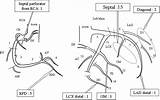 Marginal Ablation Catheter Ethanol Recurrent Ventricular Tachycardia sketch template