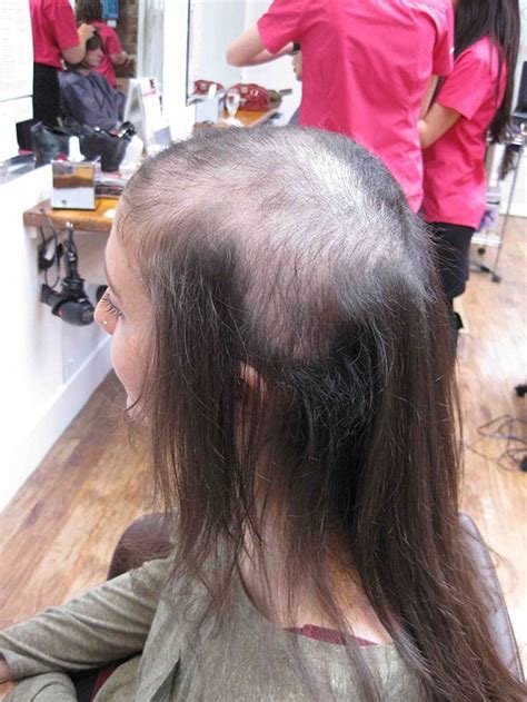 teenager left bald after pulling out all of her hair bt