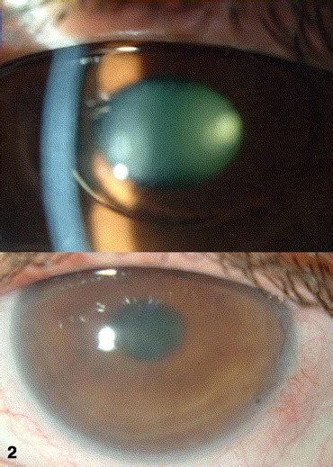 Angle Supported Anterior Chamber Phakic Intraocular Lens