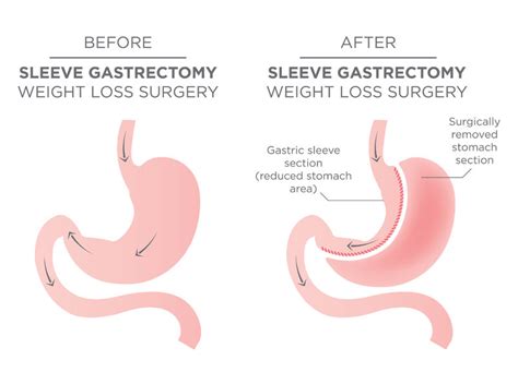 expect    gastric bypass surgery gastric