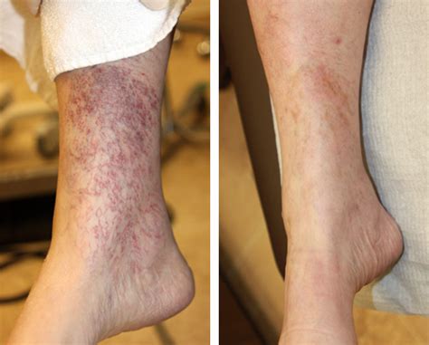 Tube stockings and leg swelling