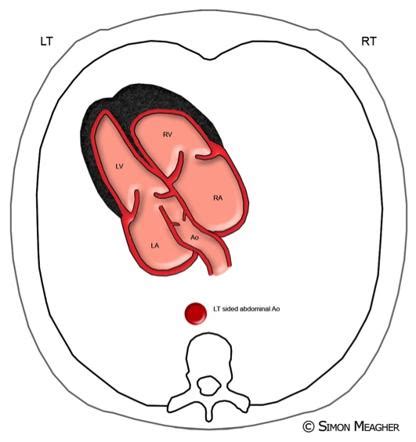 left ventricular outflow tract view fetal echocardiogram radiology reference article