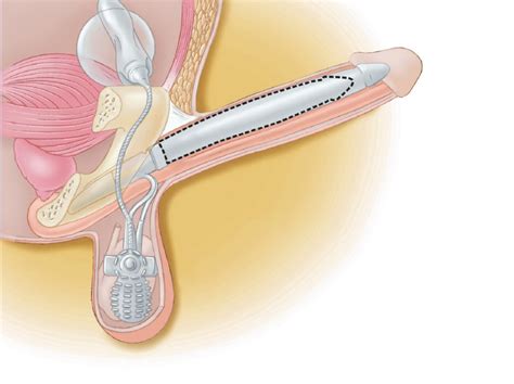 Other Types Of Penile Implants By Dr Bruce B Garber Md