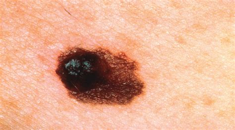 Signs And Symptoms Of Melanoma Macmillan Cancer Support