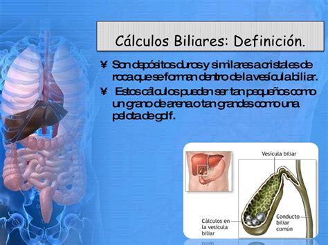calculos biliares y calculos renales
