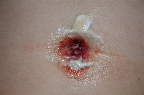 Yeast Infection Belly Button Treatment Guide