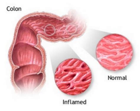 inflamed colon symptoms   treatment