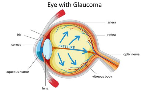 glaucoma management surgery lasers eagle eye centre